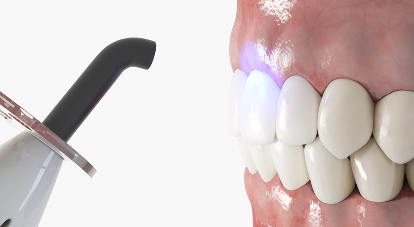 Dental Bonding