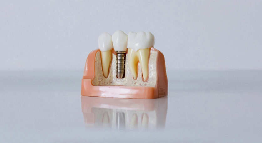 Are Dental Implants Safe for Older Adults?