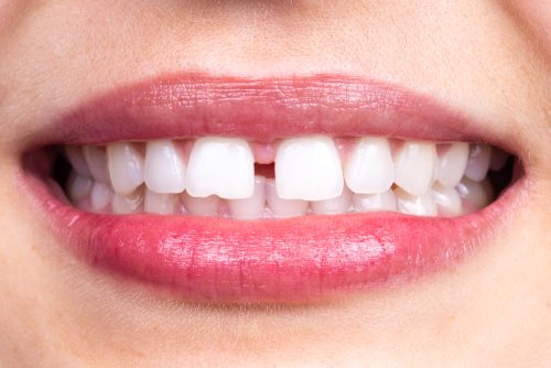 Simple Ways to Fix Teeth Gaps