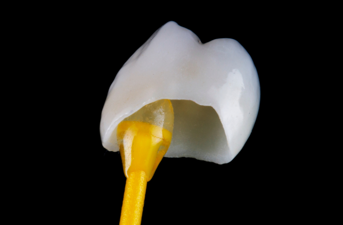 Dental Crowns in 2025: What’s New and Innovative?